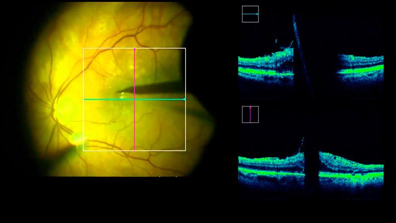 Макулярний розрив: що це і як лікується?